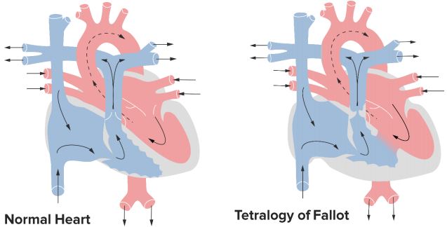 Overriding Of Aorta Definition