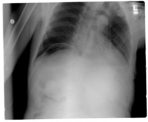 Pneumoperitoneum röntgenfoto van de borst