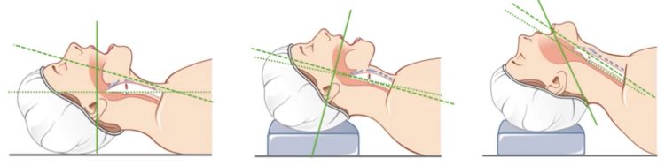 Intubation