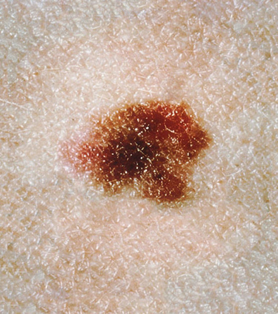 Dysplastic Nevi