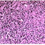 Squamous cell carcinoma