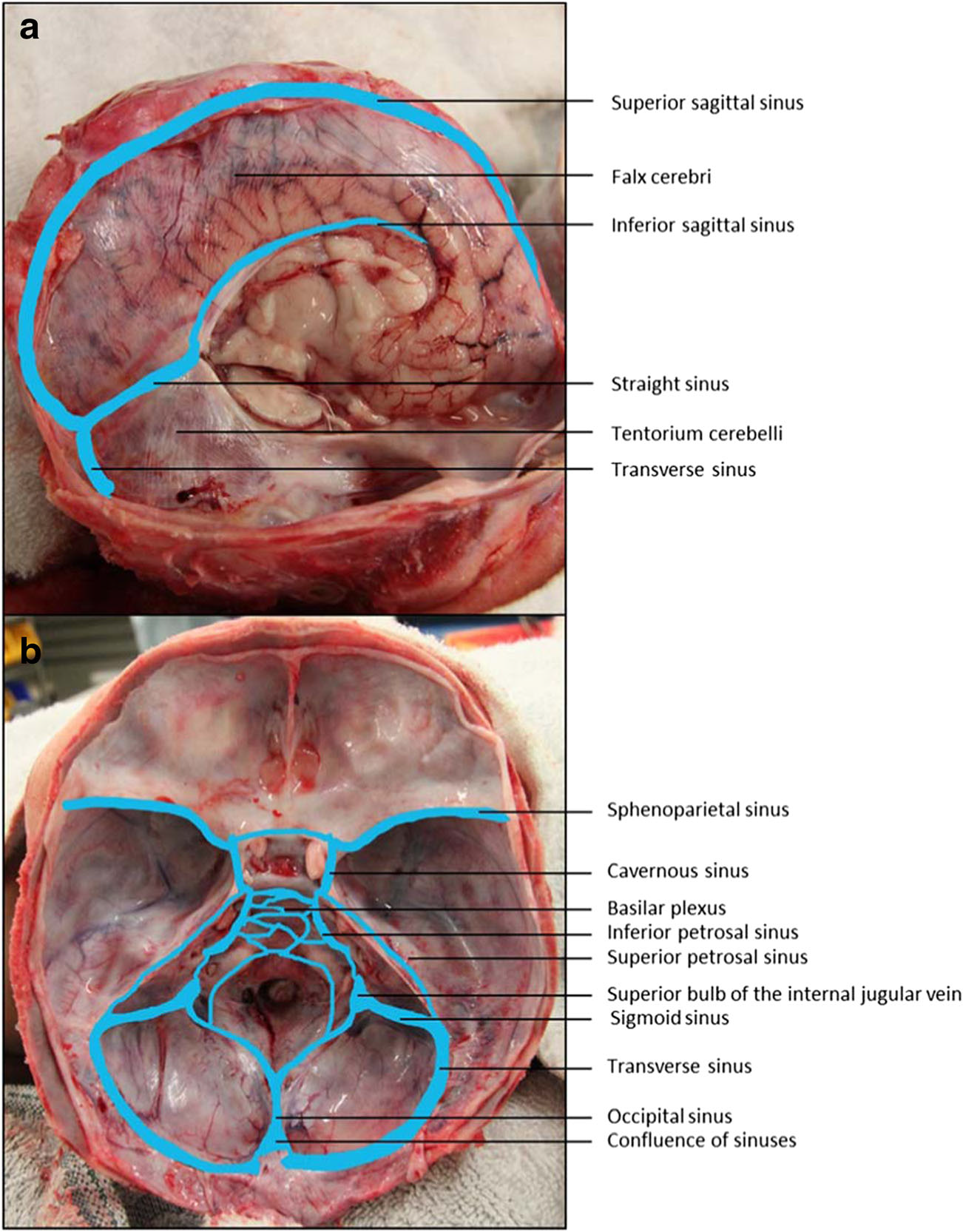 Cavernous Sinus Anatomy And Clinical Relevance Lecturio