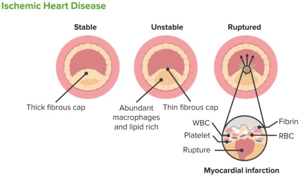 coronary-vascular-disease