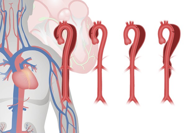 aortic dissection