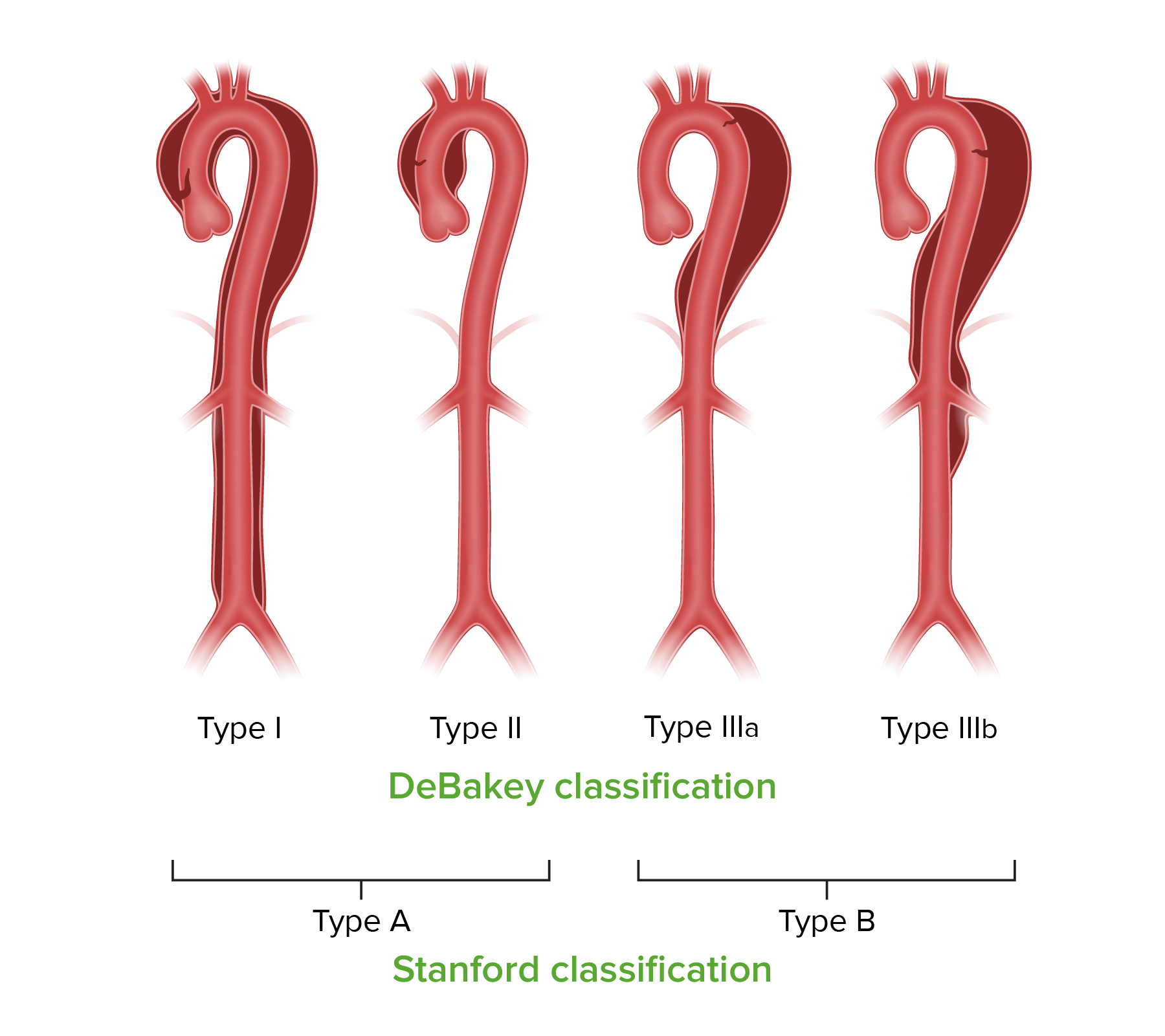 Thoracic Aortic Aneurysm Classification