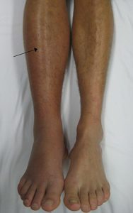 Deep-vein-thrombosis-of-the-right-leg