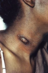 coccidiodes lesion
