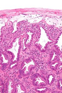 ischemic colitis high mag