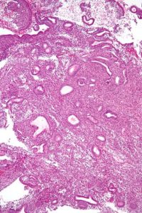 simple endometrial hyperplasia