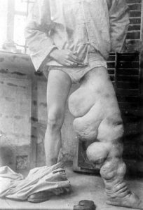 wuchereria-induced elephantiasis