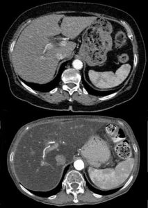 comparison ct scan of normal liver and of steatosis