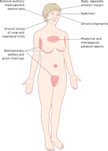 Seborrhoeic eczema