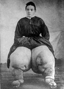 Elephantiasis