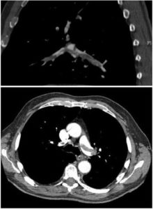 CT of pulmonary embolism