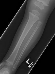 Pediatric-Tibial-Fracture