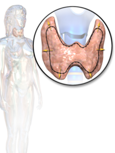 Goiter