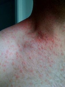 Folliculitis