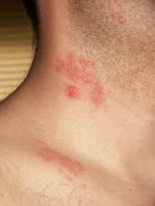 Herpes zoster neck