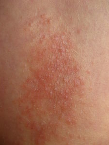 Lichen Simplex Chronicus (Neurodermatitis) — Causes and Symptoms