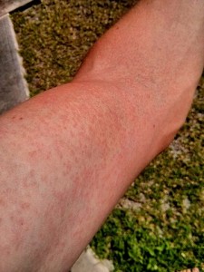 Rash on an arm due to Zika virus Rash on an arm due to Zika virus