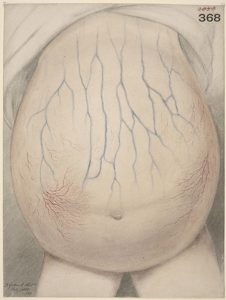 Ascites in the abdomen of a child