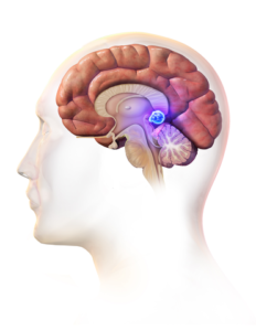pineal tumor
