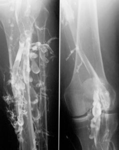 Phlebographie-Thrombose-thrombosis