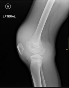 Medical-X-Ray-imaging-hemophelia