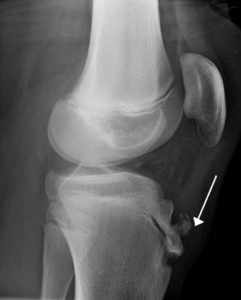 Radiograph-of-human-knee-with-Osgood-Schlatter-disease