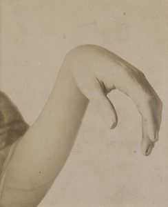 Hand after an injury to the radial nerve