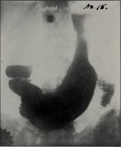 pyloric stenosis