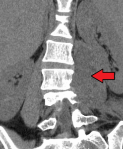 paraspinal abscess mark