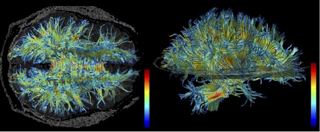 mri-structure-white-matter