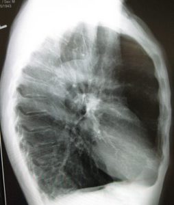 barrel chest