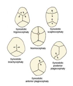 Skull deformities associated with single suture synostosis