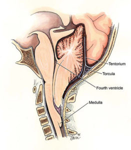 chiari 2 malformation