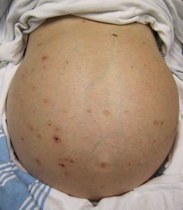 ascites