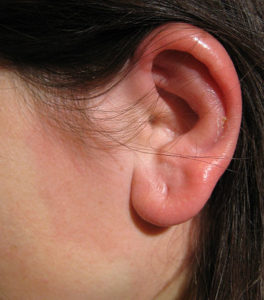 Erysipelas ear