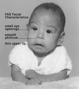 photo of baby with fas (fetal alcohol syndrome)