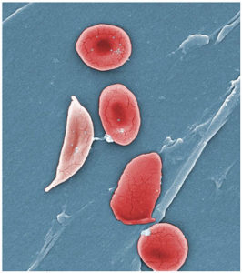 Sickle_Cells