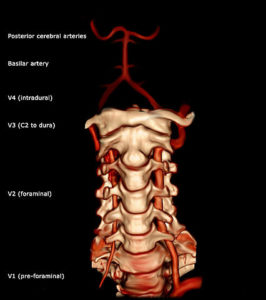 Vertebral artery 3D