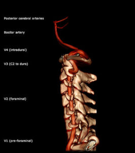 Vertebral artery 3D lateral