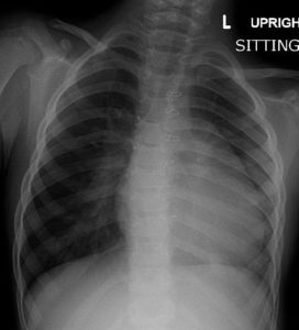 Tetralogy-of-fallout-cardiac-chest-x-ray