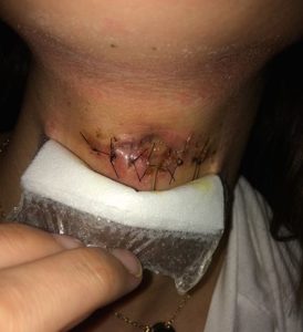 infected site of thyroglossal cyst surgery