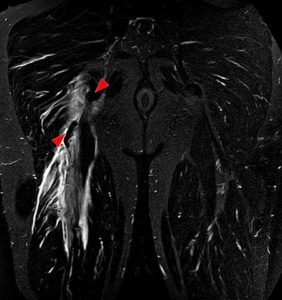 Hamstring tear lower limb anatomy