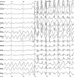 Spike-waves-Epilepsy