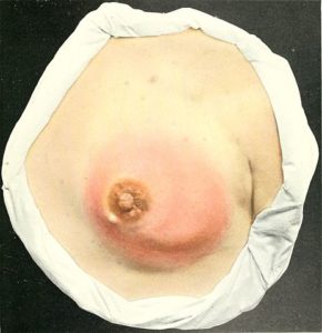 gross pathology of mastitis