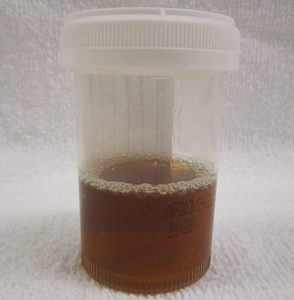 Rhabdomyolysis Urine