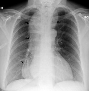 Achalasia-medical-imaging