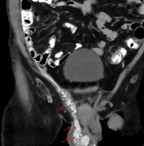 CT scan of varicocele